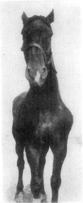 Fig. 7&mdash;Paralysis of the suprascapular nerve of the left shoulder