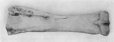 Fig. 16&mdash;Posterior view of radius (right) illustrative of
effects of splint. Note the extent of exostosis.
