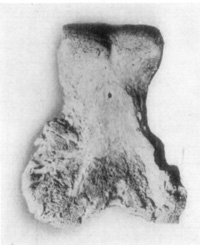 Fig. 30&mdash;Rarefying osteitis wherein articular cartilage
was destroyed in a case of arthritis of fetlock joint.