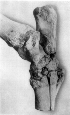 Fig. 53&mdash;Lateral (external) view of tarsus showing
effects of generalized tarsitis.