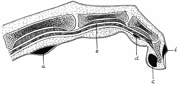 Fig. 9.&mdash;Diagram of various forms of Whitlow.
a = Purulent blister.
b = Suppuration at nail fold.
c = Subcutaneous whitlow.
d = Whitlow in sheath of flexor tendon (e).