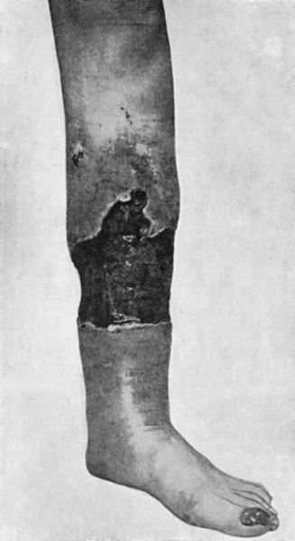 Fig. 18.&mdash;Callous Ulcer, showing thickened edges and indurated swelling of surrounding parts.