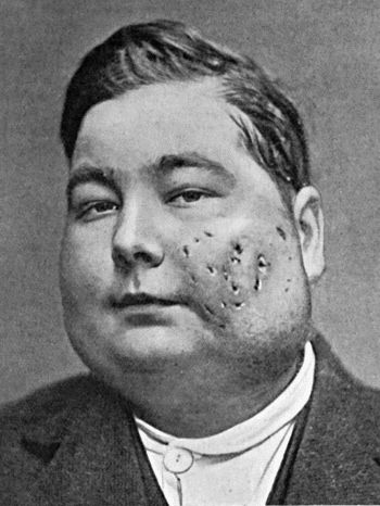 Fig. 31.&mdash;Actinomycosis of Maxilla.  The disease spread to opposite side; finally implicated base of skull, and proved fatal.  Treated by radium. (Mr. D.P.D. Wilkie's case.)