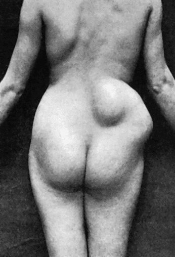 Fig. 34.&mdash;Tuberculous Abscess in right lumbar region in a woman aged thirty.