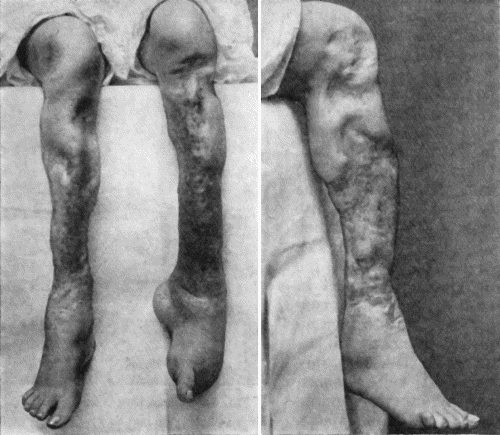 Fig. 41.&mdash;Ulceration of nineteen year's duration in a woman &aelig;t.&nbsp;24, the subject of inherited syphilis, showing active ulceration, cicatricial contraction, and sabre-blade deformity of tibi&aelig;.