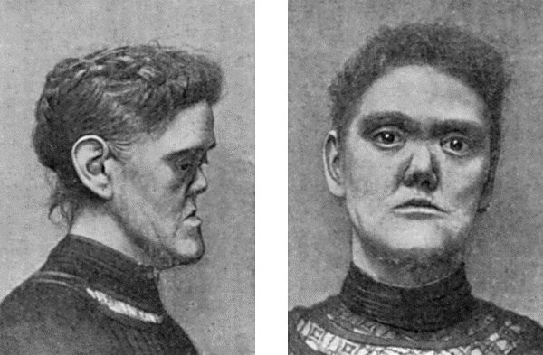 Fig. 44.&mdash;Facies of Inherited Syphilis.