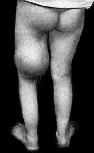 Fig. 55.&mdash;Recurrent Sarcoma of Sciatic Nerve in a woman &aelig;t.&nbsp;27. Recurrence twenty months after removal of primary growth.