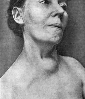 Fig. 75.&mdash;Innominate Aneurysm in a woman, &aelig;t.&nbsp;47, eight months after treatment by Moore-Corradi method (cf. Fig. 73).