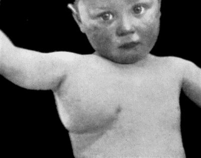 Fig. 76.&mdash;Congenital Cystic Tumour or Hygroma of Axilla. (From a photograph lent by Dr. Lediard.)