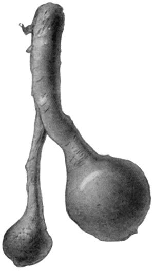 Fig. 84.&mdash;Stump Neuromas of Sciatic Nerve, excised forty years after the original amputation by Mr. A.G. Miller.