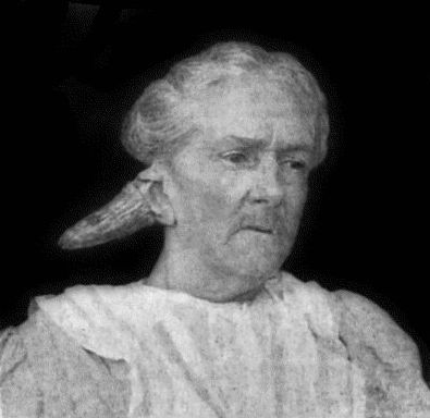 Fig. 100.&mdash;Sebaceous Horn growing from Auricle. (Dr. Kenneth Maclachan's case.)