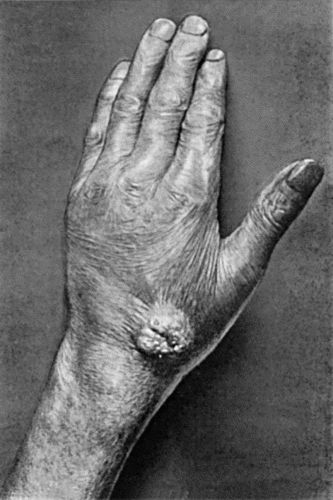 Fig. 101.&mdash;Paraffin Epithelioma.