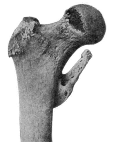 Fig. 110.&mdash;Ossification in Tendon of Ilio-psoas Muscle.