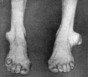 Fig. 117.&mdash;Gouty Disease of Burs&aelig; in a tailor. The bursal tumours were almost entirely composed of urate of soda. (Cf. Fig. 114.)