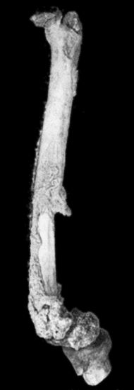 Fig. 119.&mdash;Femur and Tibia showing results of Acute Osteomyelitis affecting Trigone of Femur; sequestrum partly surrounded by new case; backward displacement of lower epiphysis and implication of knee-joint.