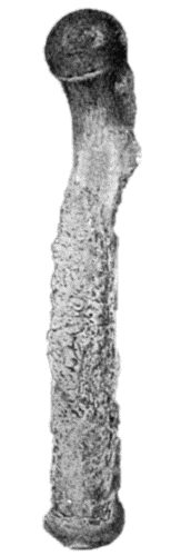 Fig. 123.&mdash;New Periosteal Bone on surface of Femur from Amputation Stump. Osteomyelitis supervened on the amputation, and resulted in necrosis at the sawn section of the bone. (Anatomical Museum, University of Edinburgh.)