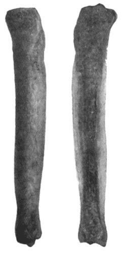 Fig. 131.&mdash;Syphilitic Hyperostosis and Sclerosis of Tibia, on section and on surface view.