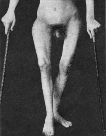 Fig. 136.&mdash;Osteomyelitis Fibrosa affecting Femora in a man &aelig;t.&nbsp;19. The curving of the bones is due to multiple fractures.