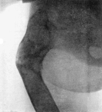 Fig. 137.&mdash;Radiogram of Upper End of Femur showing appearances in Osteomyelitis Fibrosa.