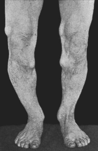 Fig. 139.&mdash;Multiple Exotoses of both limbs. (Photograph lent by Sir George T. Beatson.)