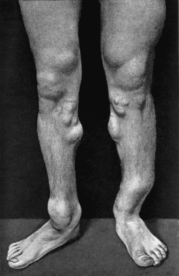 Fig. 141.&mdash;Multiple Cartilaginous Exostoses in a man &aelig;t.&nbsp;27, the same as in Fig. 140.