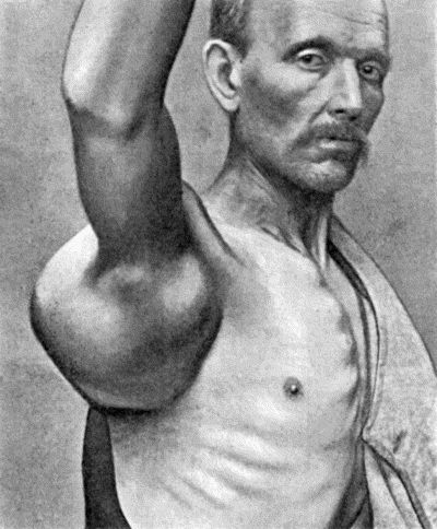 Fig. 148.&mdash;Chondro-Sarcoma of Scapula in a man &aelig;t.&nbsp;63; removal of the scapula was followed two years later by metastases and death.