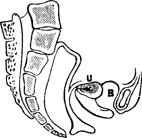 Illustration:
Fig. 14. Anteversion, U, Uterus, B, Bladder.