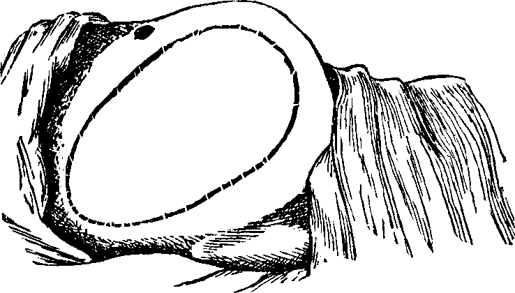 Illustration:
Fig. 17. The shape and position of the Tumor are shown by the dotted line.