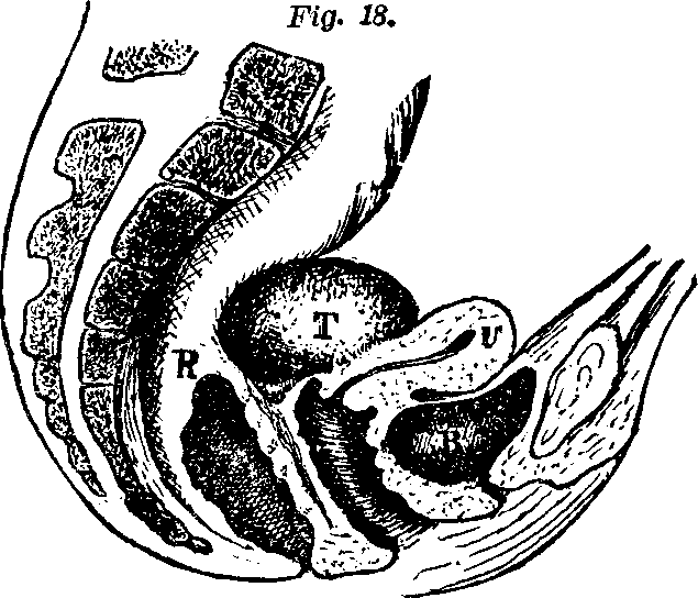Illustration:
Fig. 18. U, Uterus. B, Bladder. R, Rectum. T, Tumor.