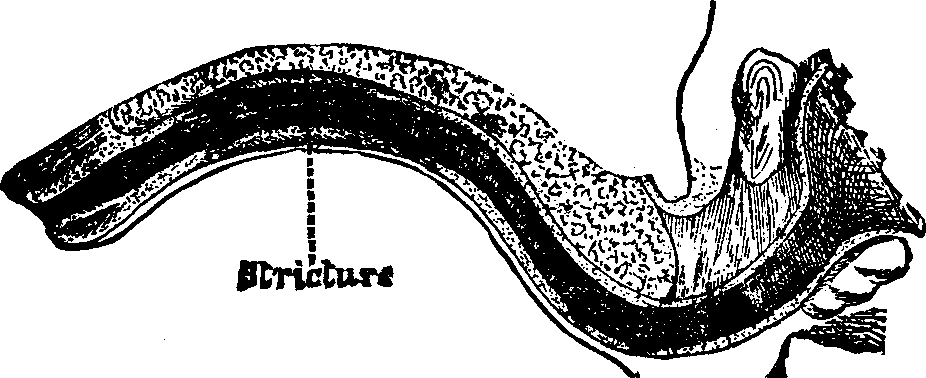 Illustration:
Fig. 2. A Single Stricture of the Urethra.