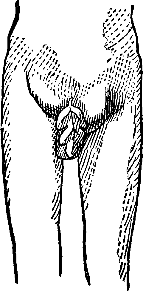 Illustration:
Fig. 1. Indirect Inguinal Hernia.