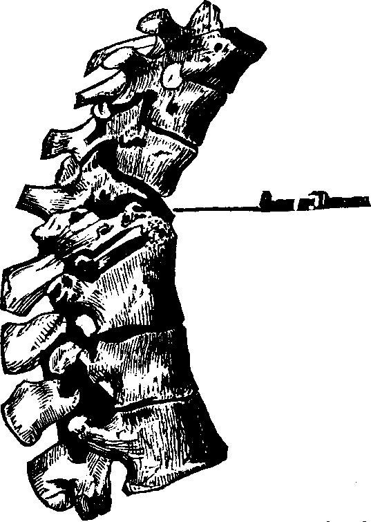 Illustration:
Fig. 1.  The above portion of the spinal column shows the manner of the
breaking down of the vertebræ from caries, and the absorption of
their bony structure.
