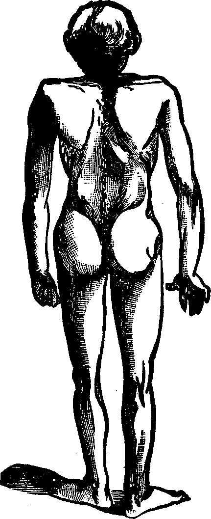 Illustration:
Fig. 4. Appearance of a child suffering from Pott's disease of the spine.