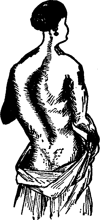 Illustration:
Fig. 7. A mild case of lateral curvature of the spine.