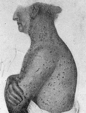 67. Pediculosis in man caused by the body
louse. After Morrow.