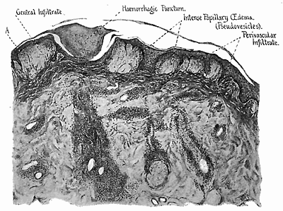 173. Fifth day mature lesion. Lower power drawing showing papillary &oelig;dema and infiltrate in the region
of the puncture.