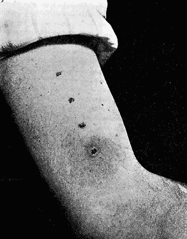 174. Experimental lesion produced from alcohol-fixed flies, dried and ground into a
paste with glycerin.