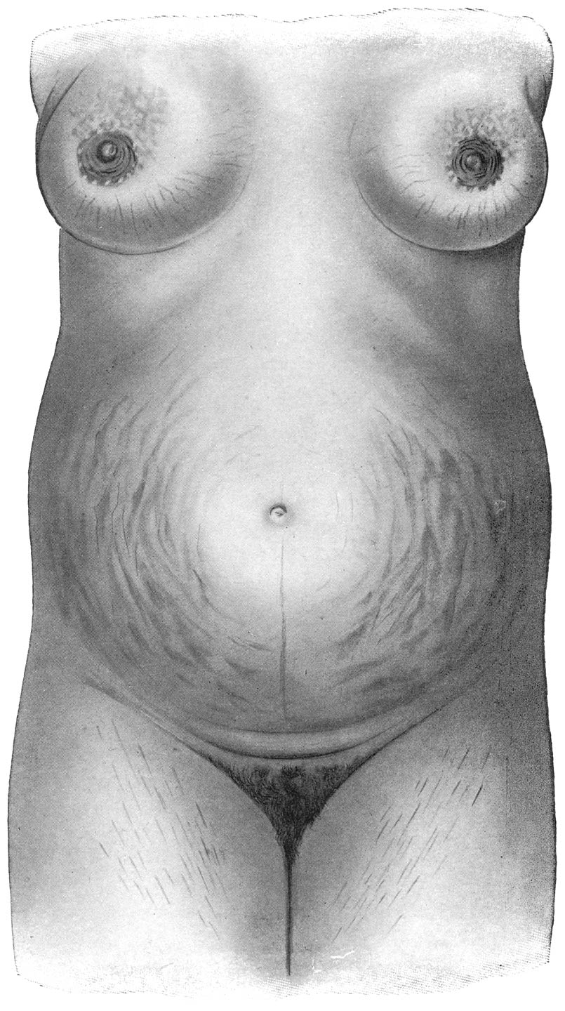Zwangerschapsstrepen en donkergekleurde lijn bij eene zwangere vrouw.