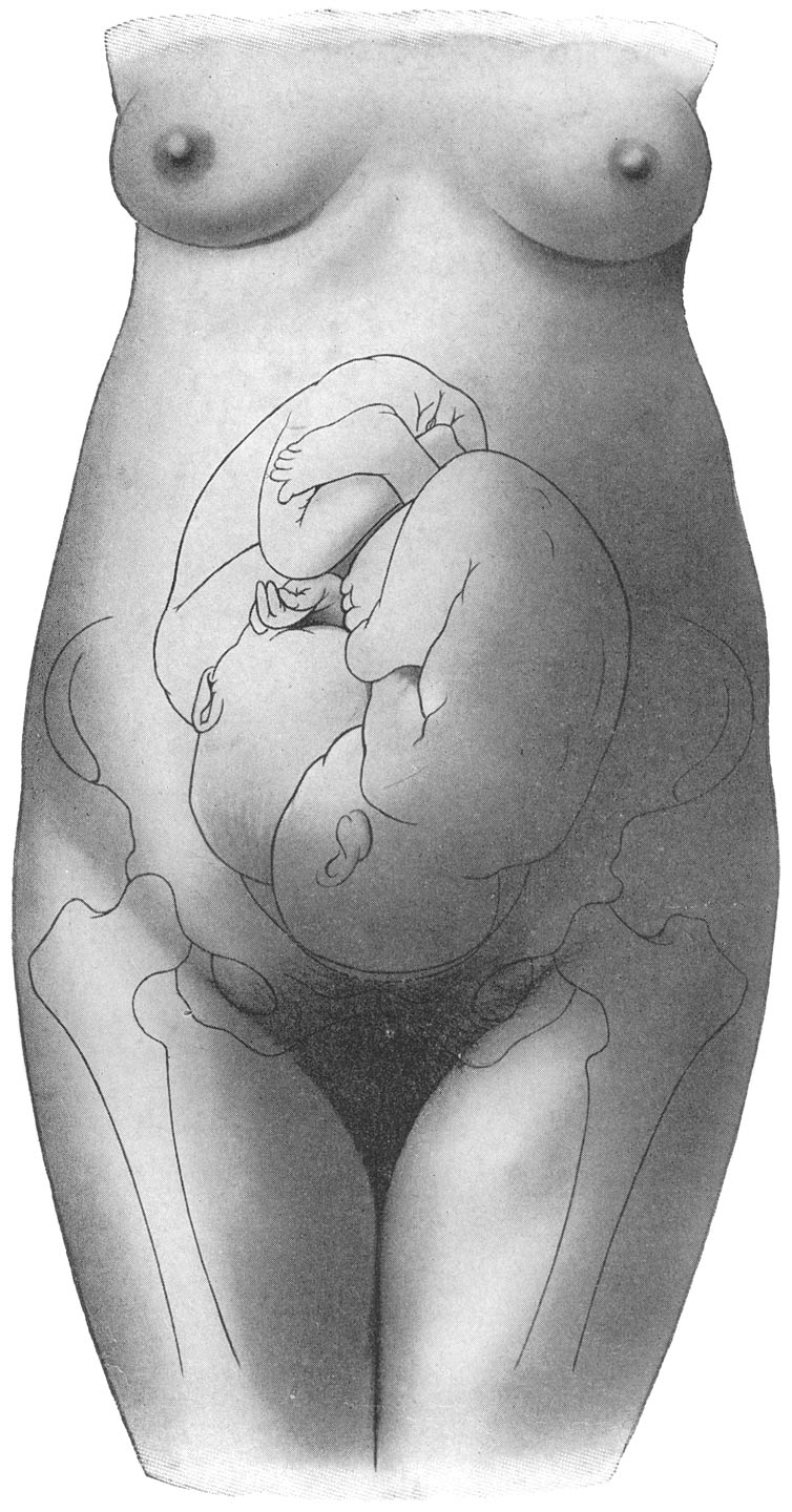 Ligging van tweelingen in den buik der zwangere vrouw, aan het einde der zwangerschap, met aanduiding van het beenige bekken.